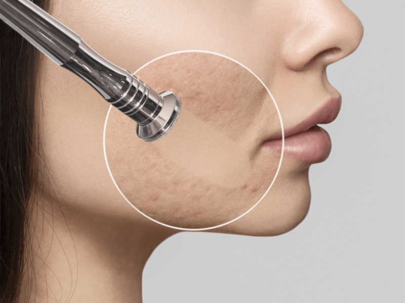 Microdermabrasion