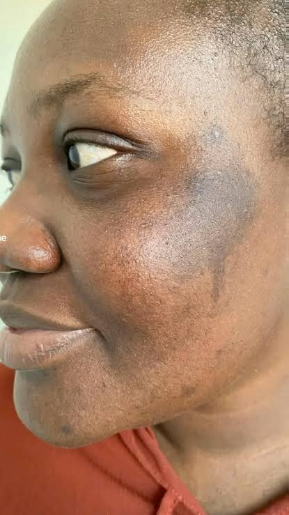 Sunburn Facial