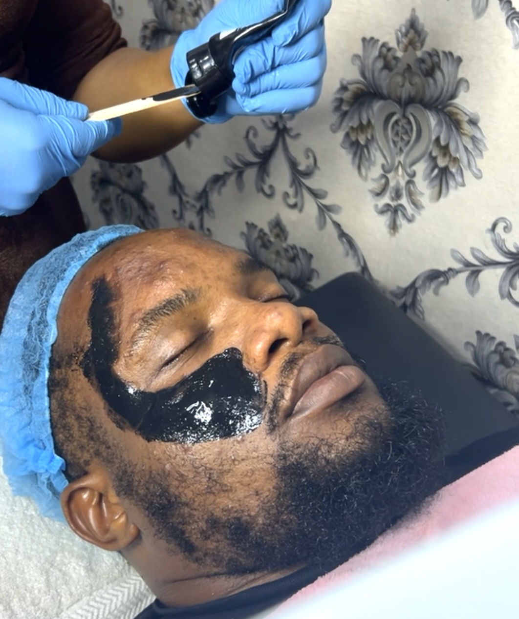 Acne Facial